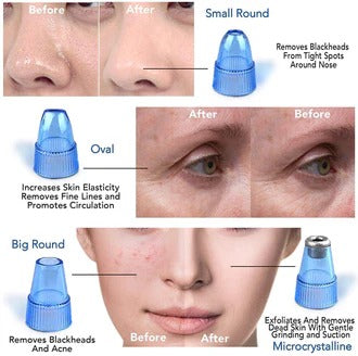 Multifunctional Electric Blackhead Remover